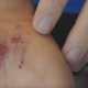 First Aid : Treating Cuts, Scrapes and Lacerations