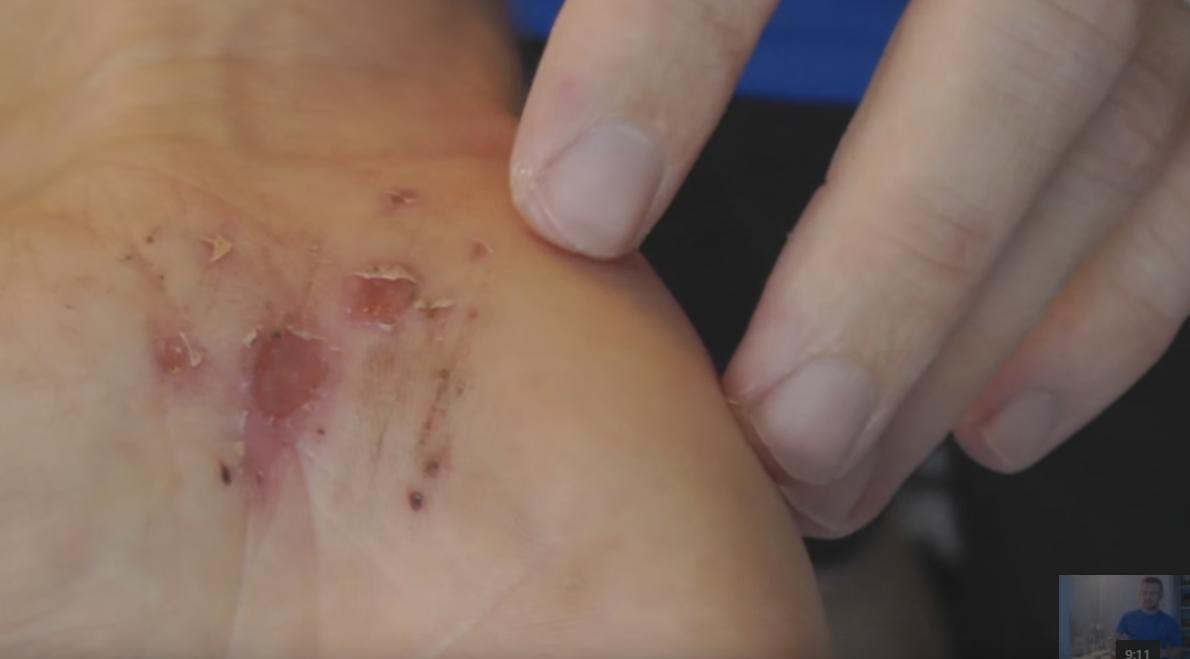 First Aid : Treating Cuts, Scrapes and Lacerations
